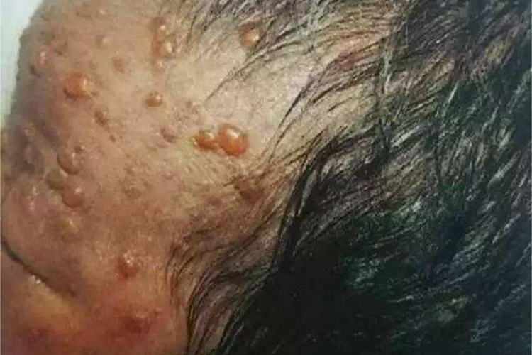 角层下脓疱性皮病前额症状图