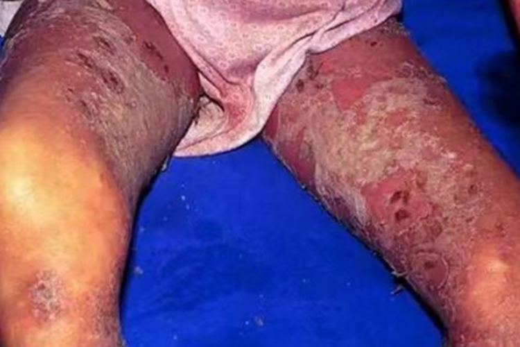 疱疹样脓疱病大腿结痂图