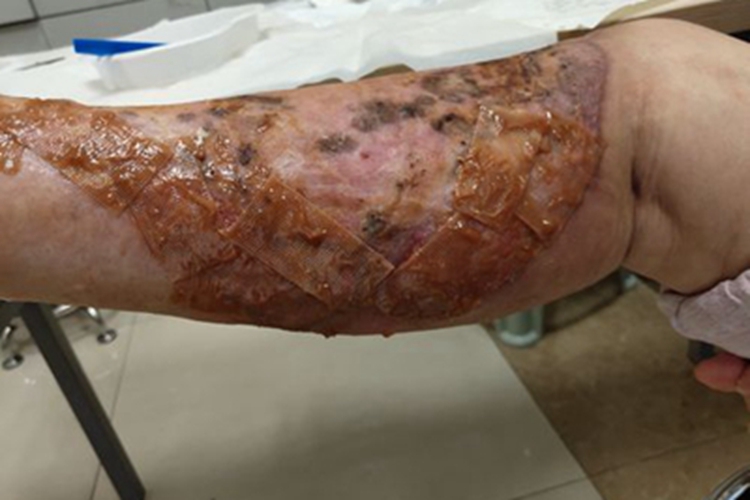 溃疡性皮肤结核小腿溃烂图 溃疡性皮肤结核小腿溃烂图