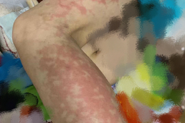 火激红斑腿上遍布红斑图