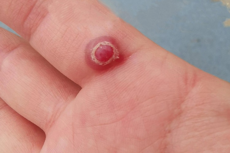 化脓性肉芽肿手掌大包图 化脓性肉芽肿手掌大包图