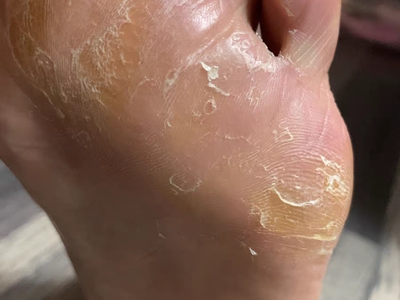 鳞屑角化型足癣脚底皮肤粗糙发黄图jpg
