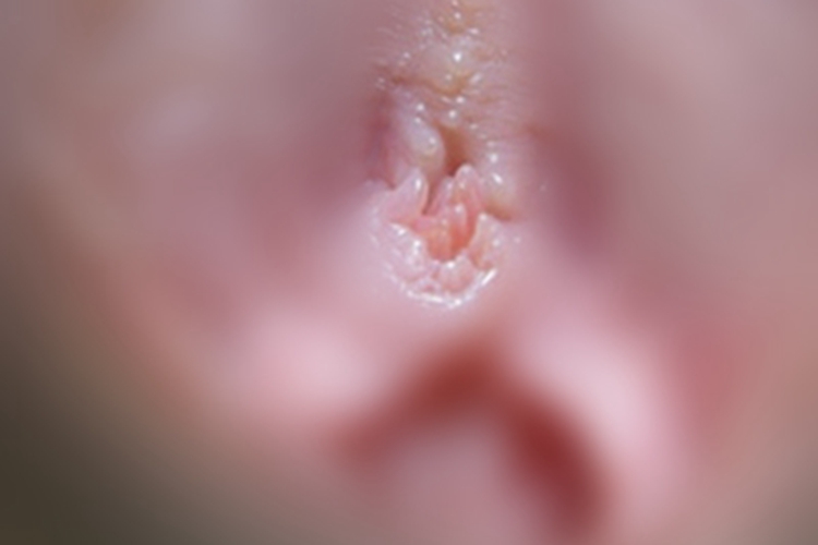 女性生殖器疱疹小疙瘩图 女性生殖器疱疹小疙瘩图