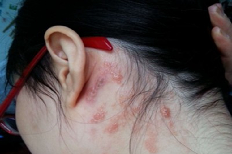 寻常狼疮耳后红色结节图