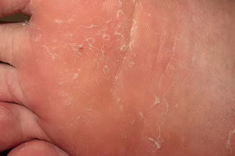 剥脱性角质松解症症状图