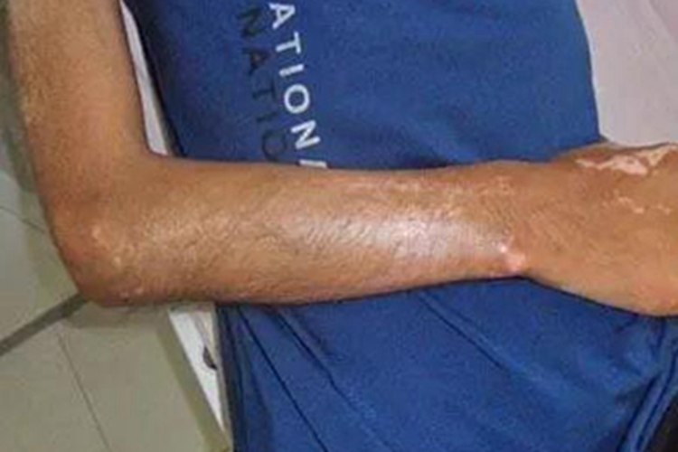 硬皮病胳膊僵硬图