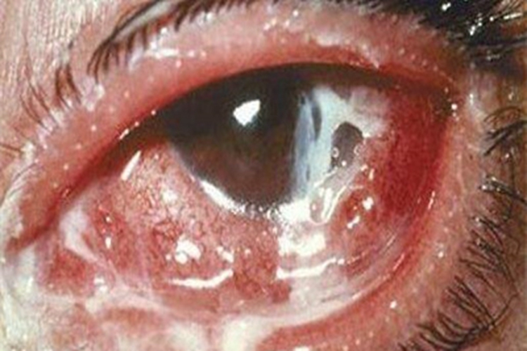 细菌性结膜炎结膜化脓图