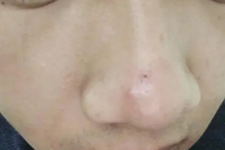 扩张孔鼻子上有个黑点图