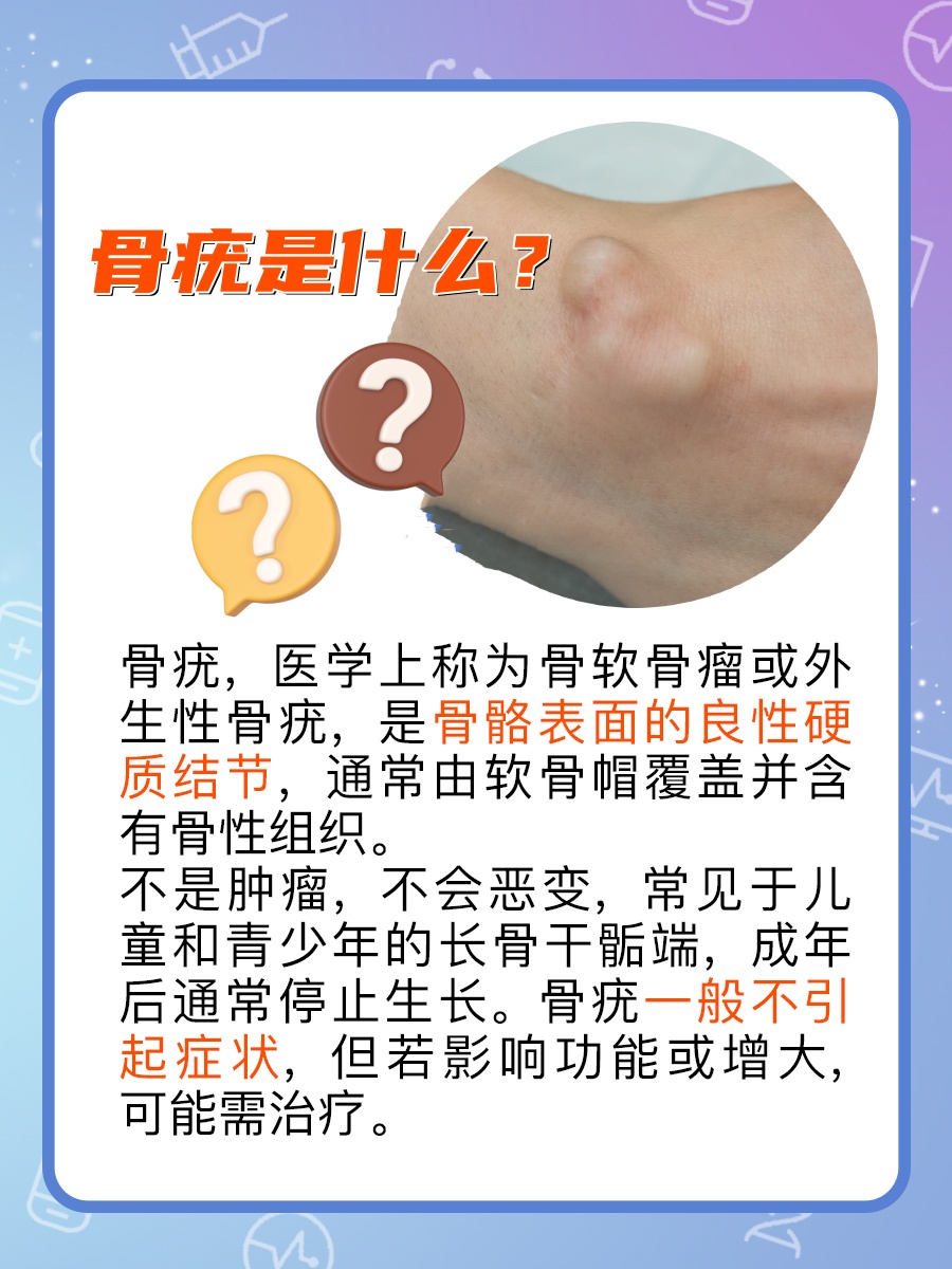 揭秘骨疣:骨骼上的良性小突起