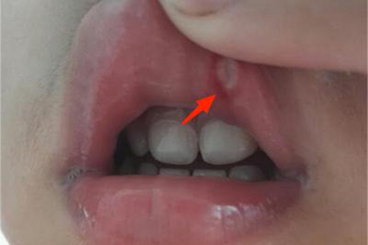 白塞病上嘴唇内侧有溃疡图 白塞病上嘴唇内侧有溃疡图