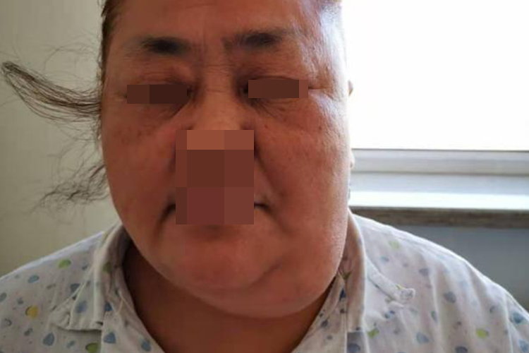 女性左侧颌下腺肿瘤图