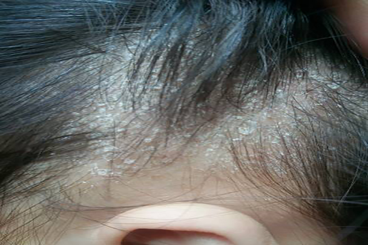 儿童白色糠样鳞屑图 儿童白色糠样鳞屑图