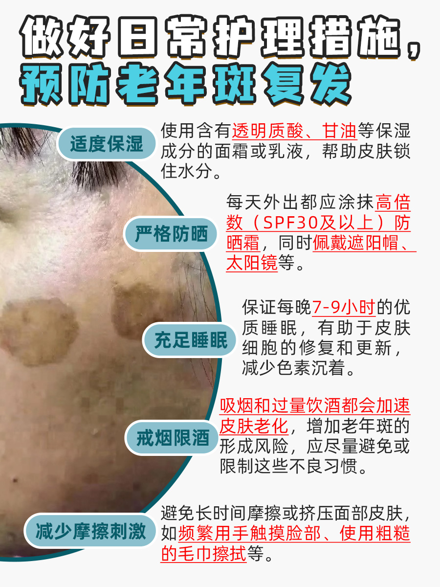 老年斑困扰?找准激光治疗的黄金时间