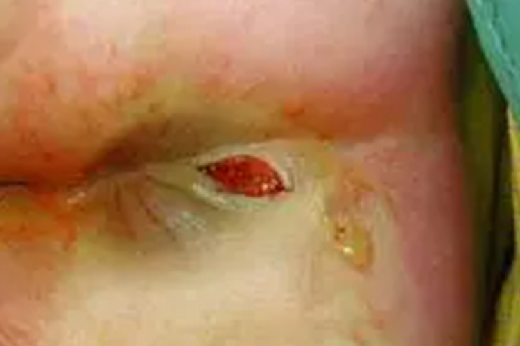 低位肛瘘早期瘘口图