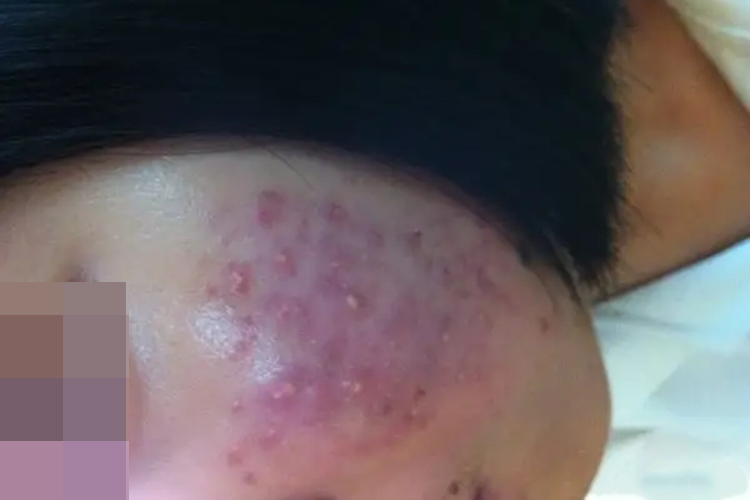 马拉色菌脸部感染脓疱图