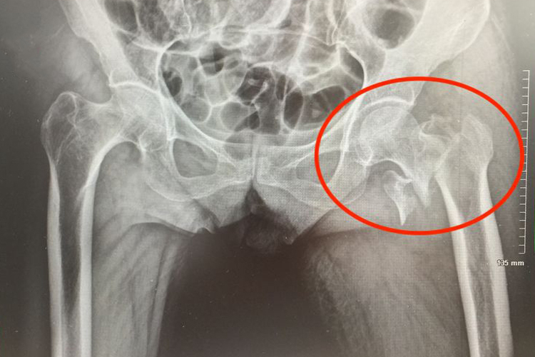 股骨颈骨折图 股骨颈骨折图