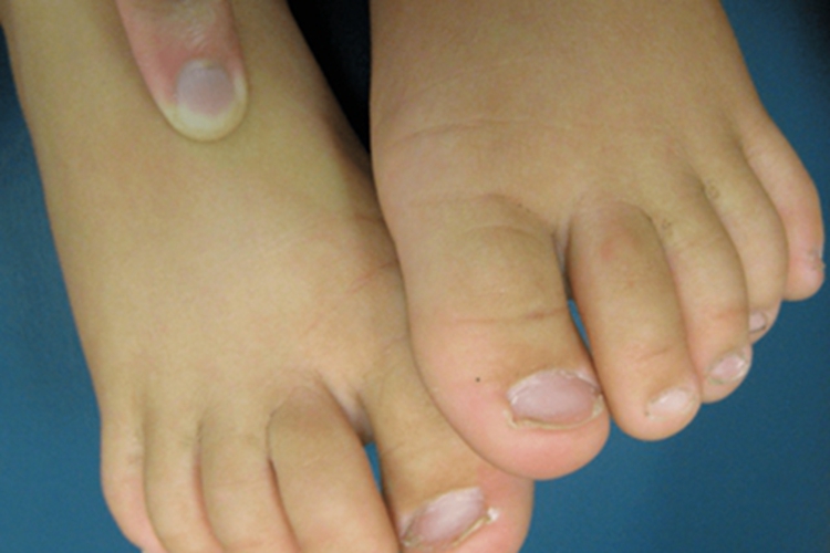 反甲脚趾甲上翘图 反甲脚趾甲上翘图