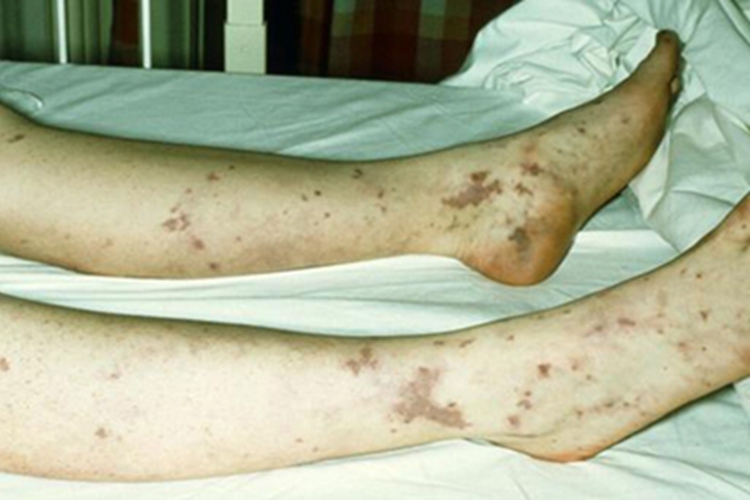 急性白血病红斑图