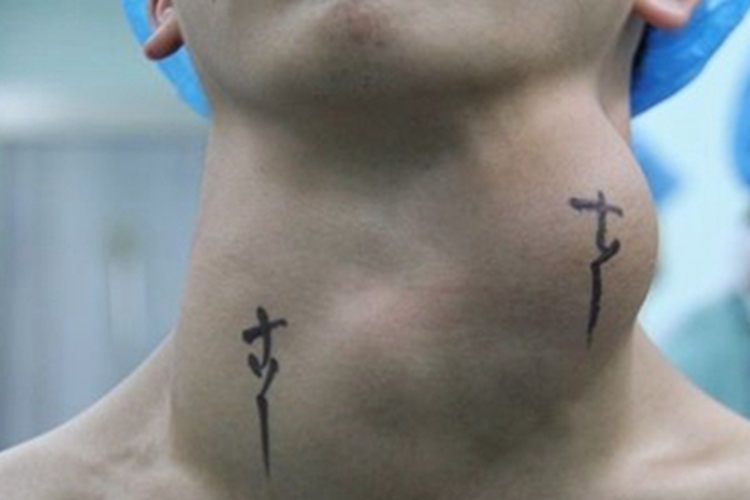 单纯性甲状腺肿颈部有凸起肿块图