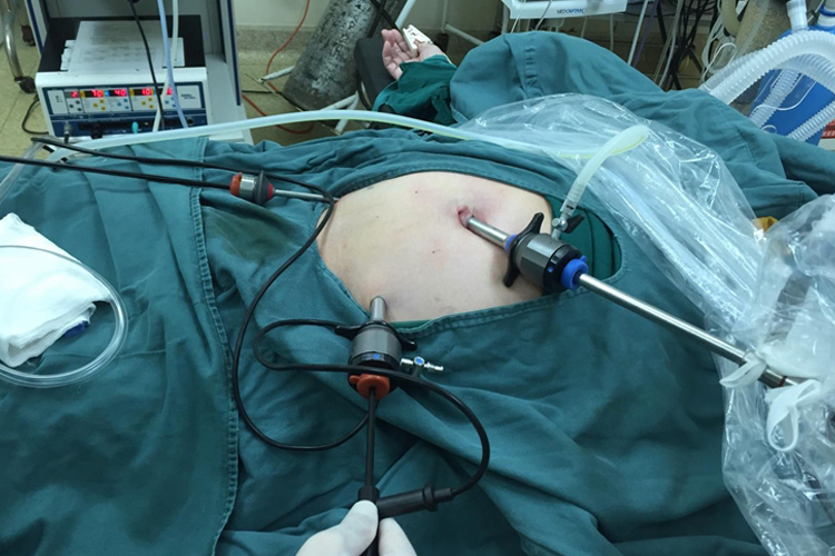 阑尾炎微创手术图