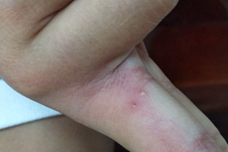 皮肤感染手指缝症状图