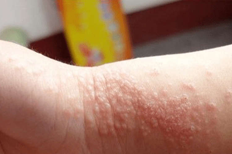 手腕急性湿疹图