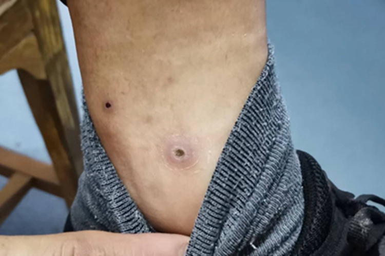 穿通性疾病小孔图