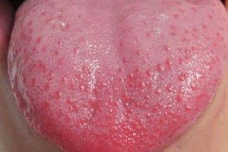 川崎病草莓舌图