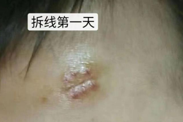 孩子额头拆线图