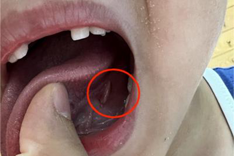 舌下腺囊肿舌侧底部有肉赘图