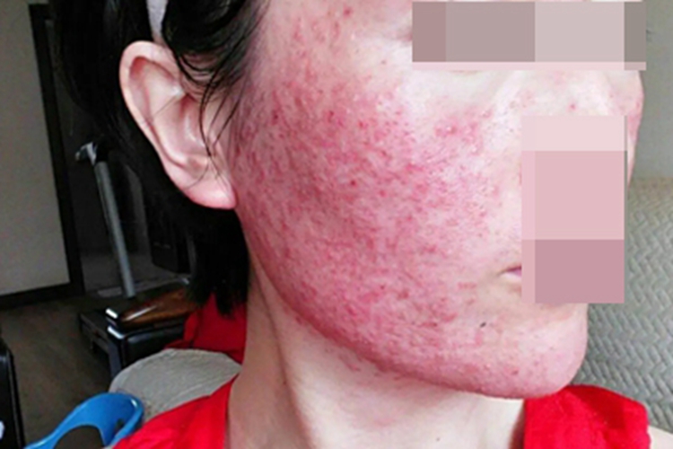 糖皮质激素依赖性皮炎脸红肿图 糖皮质激素依赖性皮炎脸红肿图