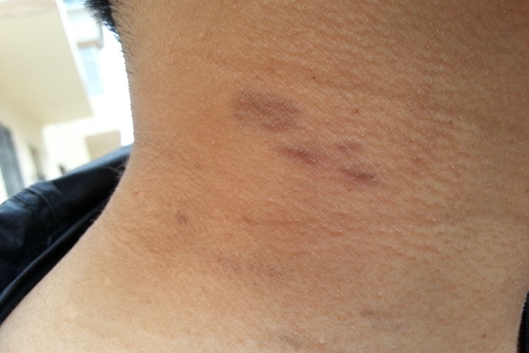 扁平苔藓样角化病颈部症状图