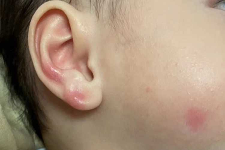 虫咬皮炎耳廓风团图