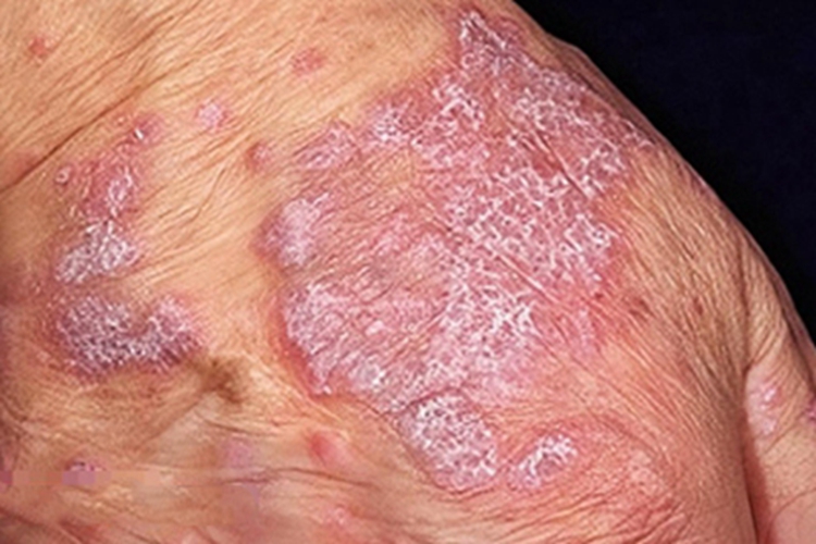 环状扁平苔藓手背有紫斑脱屑图