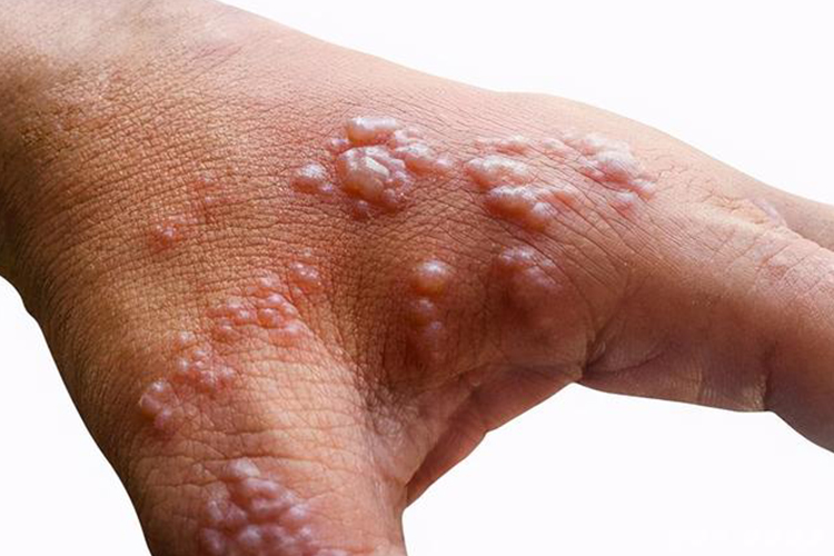 手上带状疱疹图