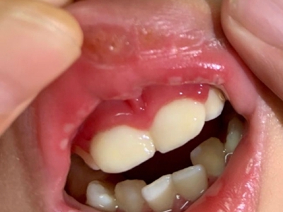 急性坏死性龈口炎的症状和图片 