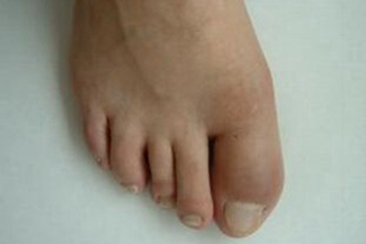 成人Still病脚趾关节肿胀图 成人Still病脚趾关节肿胀图