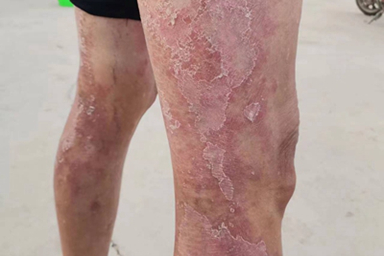 慢性湿疹腿症状图