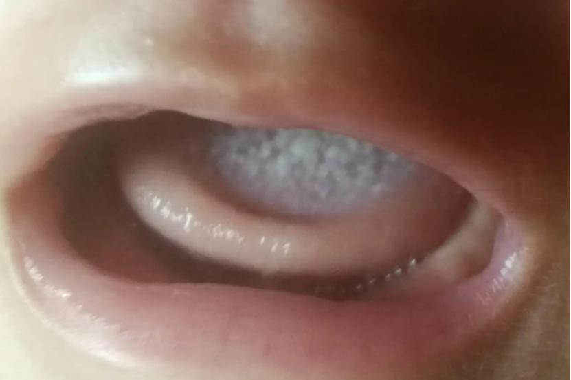 婴儿舌头奶垢图