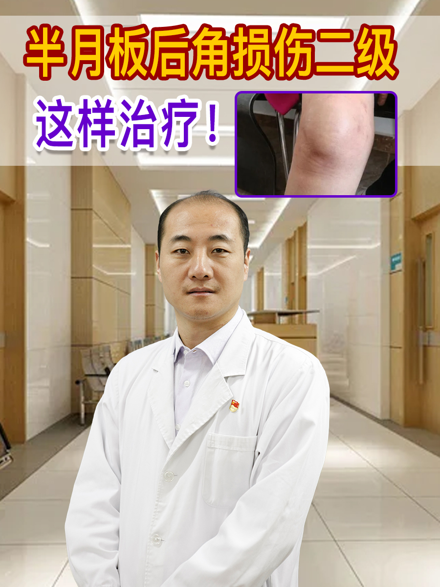 半月板后角损伤二级,这样治疗!