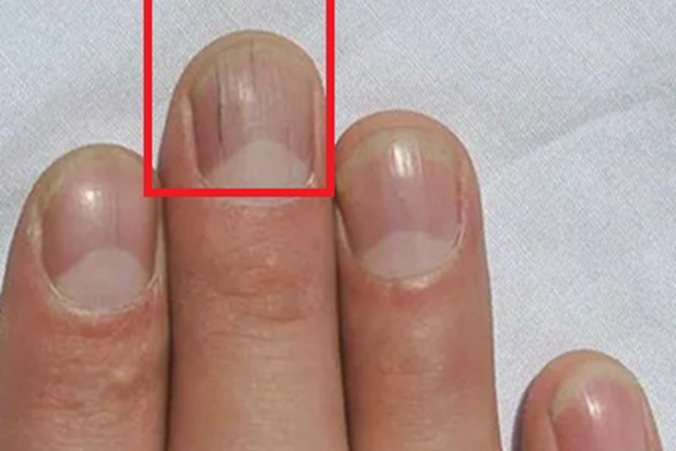 甲纵裂甲面有裂口图