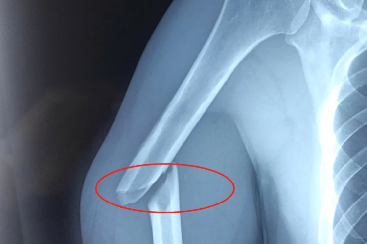 手臂骨折真实影像图 手臂骨折真实影像图