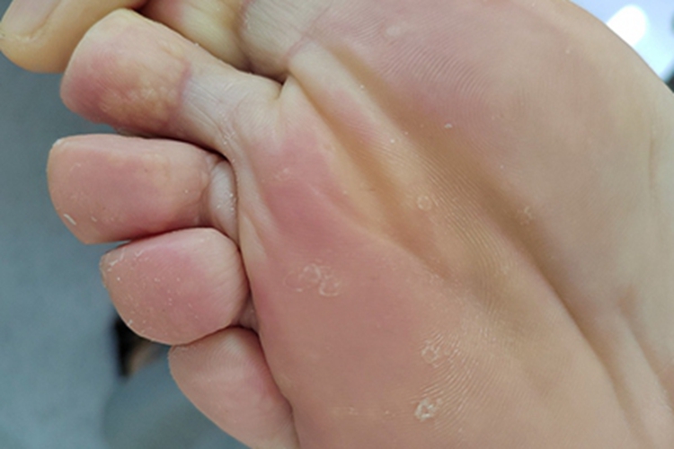 汗疱疹脚底有点状脱屑图