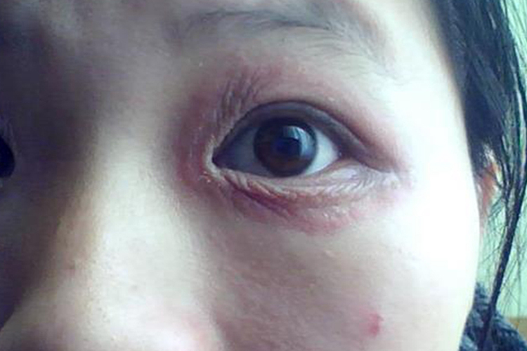 亚急性和慢性接触性皮炎图