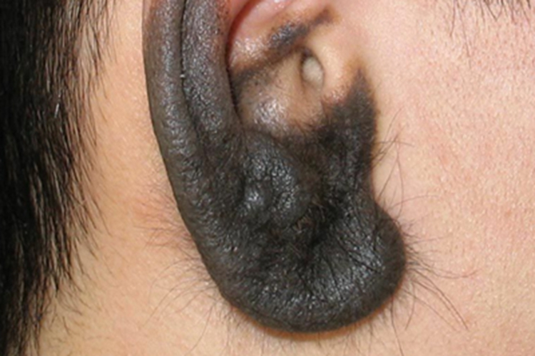 皮内痣耳部皮肤发黑图