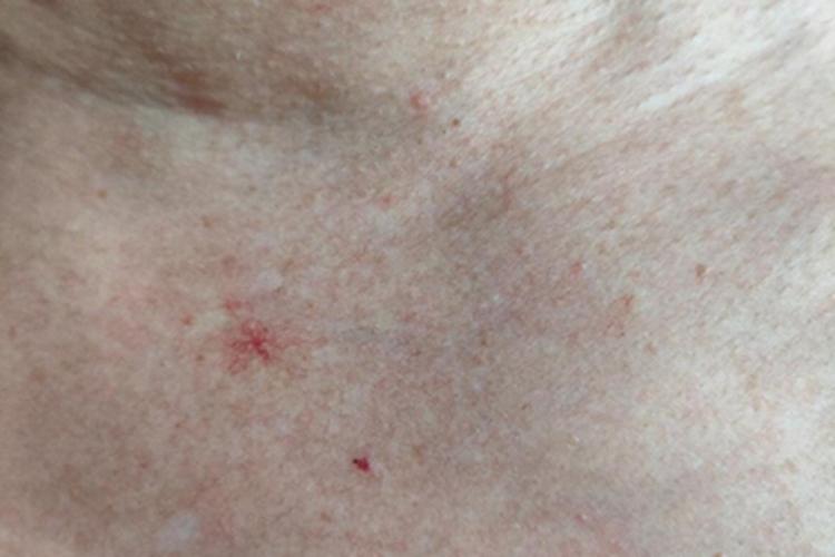 蜘蛛痣胸部丘疹图