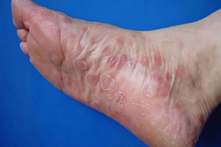 战壕热脚部症状图 战壕热脚部症状图