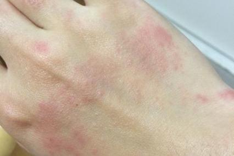 手过敏局部红斑图
