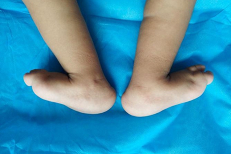 先天性垂直距骨畸形图