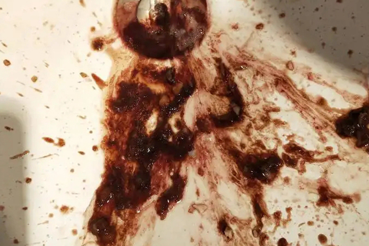 胃出血咖啡色样呕吐物图